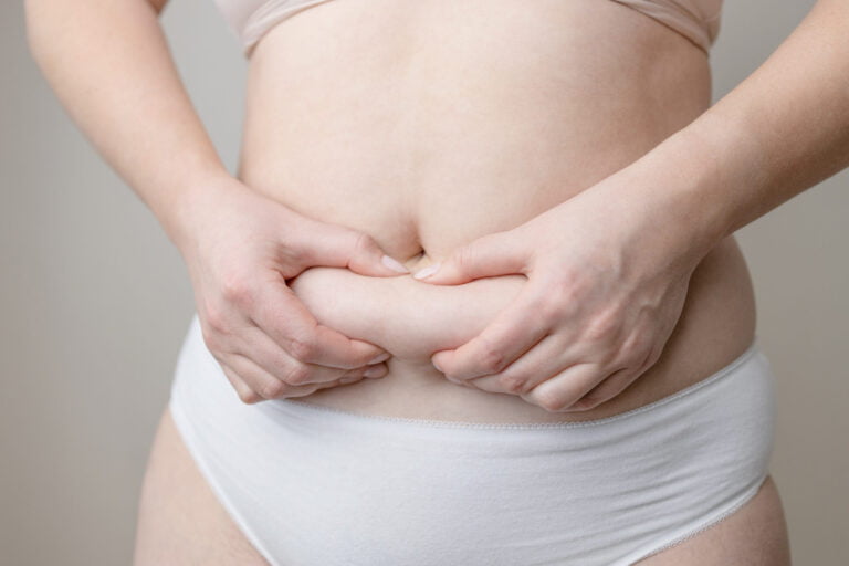 Woman holding visceral abdominal fat, illustrating visceral fat surgery options.